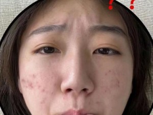 6个神奇方法帮你快速去除痘疤（探索去除痘疤的有效秘笈，让你恢复光滑肌肤）